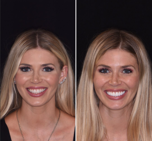 Before smile makeover
